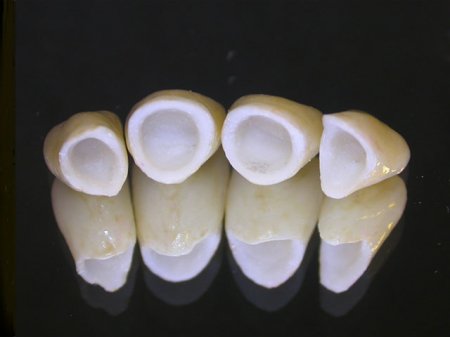 Какие зубные коронки выбрать?